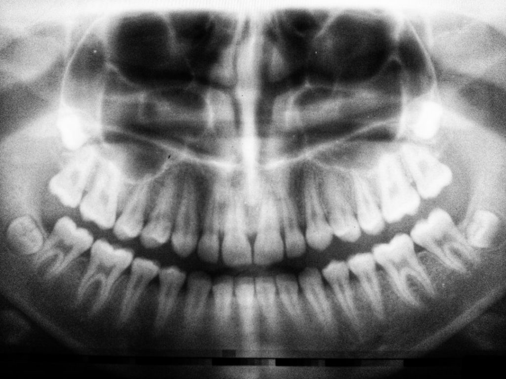 Dental implants time consuming